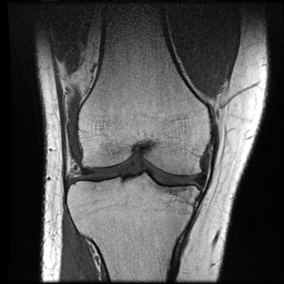 File:Anterior cruciate ligament tear with posteromedial corner injury, bucket-handle meniscal tear and chondral delamination (Radiopaedia 75501-86744 Coronal T1 13).jpg