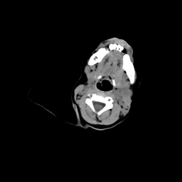 Anterior fontanelle inclusion cyst (Radiopaedia 62003-70087 Axial non-contrast 4).jpg