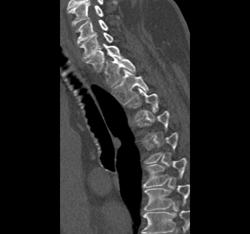 Anterior glenohumeral dislocation with Hill-Sachs lesion (Radiopaedia 62877-71249 Sagittal bone window 80).jpg