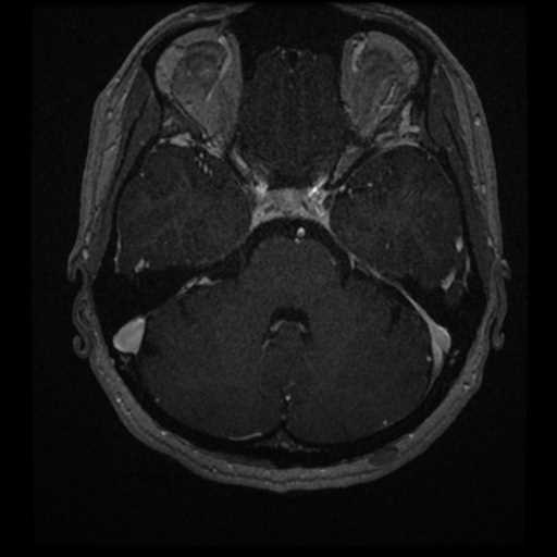 Anterior inferior cerebellar artery vascular loop - type II (Radiopaedia 70991-81209 Axial T1 C+ 25).jpg