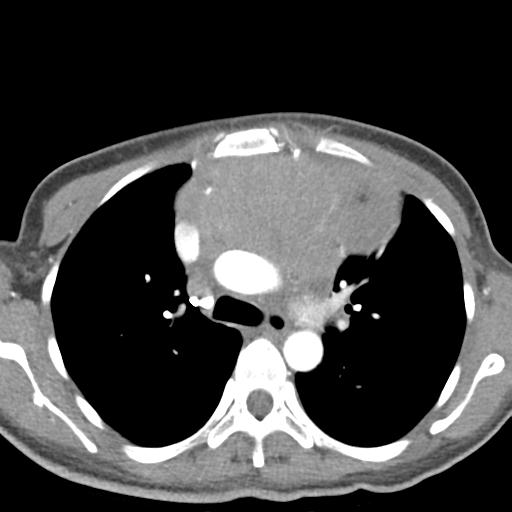 File:Anterior mediastinal lymphoma (Radiopaedia 29556-30061 C 19).jpg