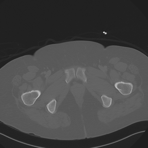 Anterior superior iliac spine avulsion fracture (Radiopaedia 44541-48244 Axial bone window 102).png