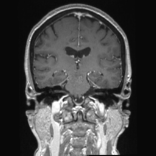 Anterior temporal pole cysts (Radiopaedia 46629-51102 Coronal T1 C+ 78).png