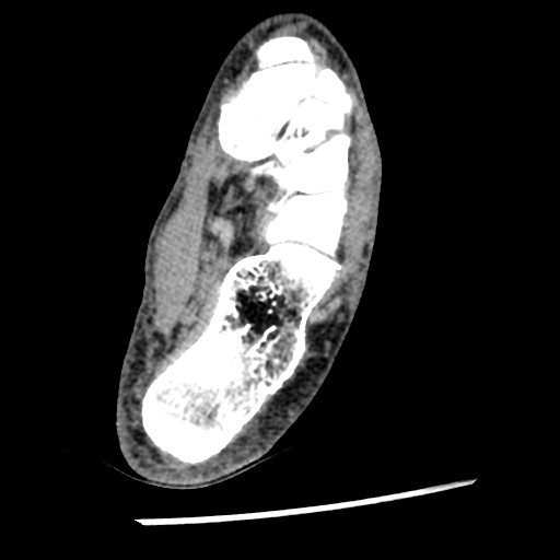 Anterior tibial artery false aneurysm (Radiopaedia 88984-105809 A 190).jpg
