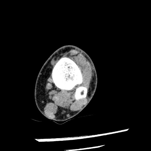 Anterior tibial artery false aneurysm (Radiopaedia 88984-105809 A 77).jpg