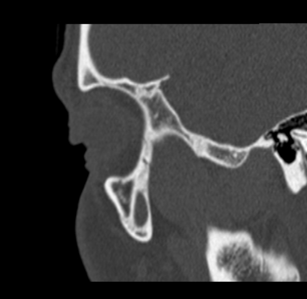 Antrochoanal polyp (Radiopaedia 33984-35202 Sagittal bone window 4).jpg