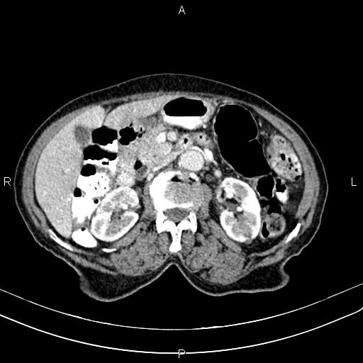 File:Aortic aneurysm and Lemmel syndrome (Radiopaedia 86499-102554 A 34).jpg