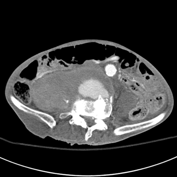 File:Aortic aneurysm with spinal destruction (Radiopaedia 42301-45410 A 66).jpg