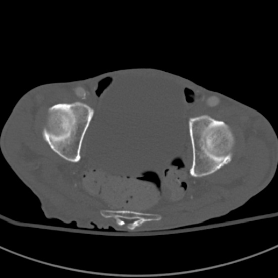 Aortic aneurysm with spinal destruction (Radiopaedia 42301-45410 Axial bone window 100).jpg