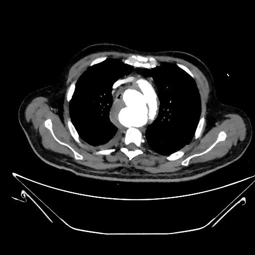 Aortic arch aneurysm (Radiopaedia 84109-99365 C 97).jpg