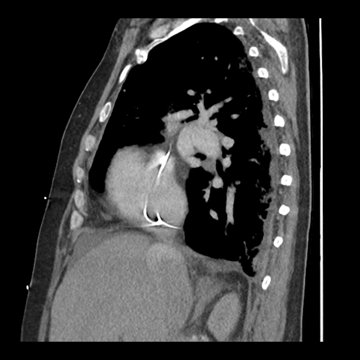 Aortic arch graft infection (FDG PET-CT) (Radiopaedia 71975-82437 C 23).jpg