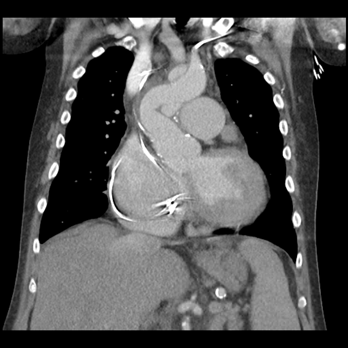 Aortic arch graft infection (FDG PET-CT) (Radiopaedia 71975-82437 Coronal 26).jpg