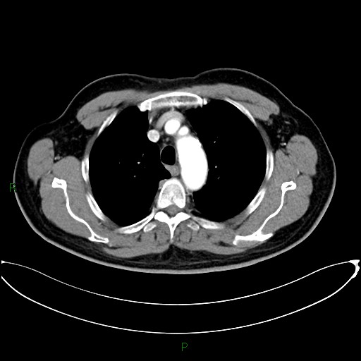 File:Aortic arch origin of left vertebral artery (Radiopaedia 46327-50737 Axial post contrast 32).jpg