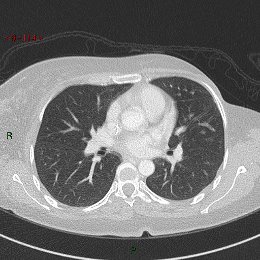 Aortic arch origin of left vertebral artery (Radiopaedia 51520-57286 Axial lung window 114).jpg