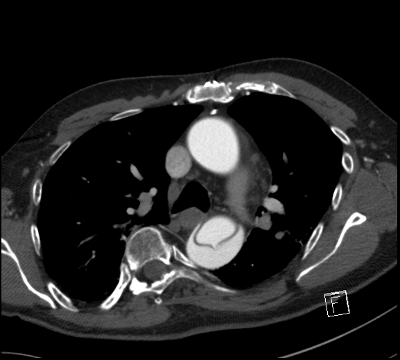 File:Aortic dissection (CTPA) (Radiopaedia 75506-86750 A 36).jpg
