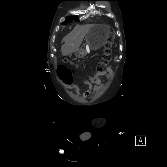 Aortic dissection (CTPA) (Radiopaedia 75506-86750 F 7).jpg
