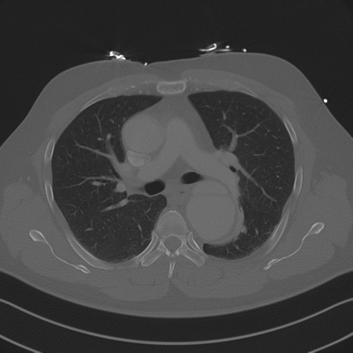 Aortic dissection (Radiopaedia 50763-56234 Axial bone window 47).png