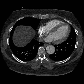 File:Aortic dissection (Radiopaedia 57969-64959 A 208).jpg