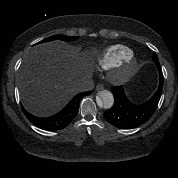 File:Aortic dissection (Radiopaedia 57969-64959 A 239).jpg