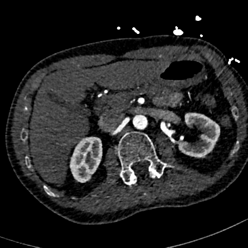 File:Aortic dissection - DeBakey type II (Radiopaedia 64302-73082 A 99).png