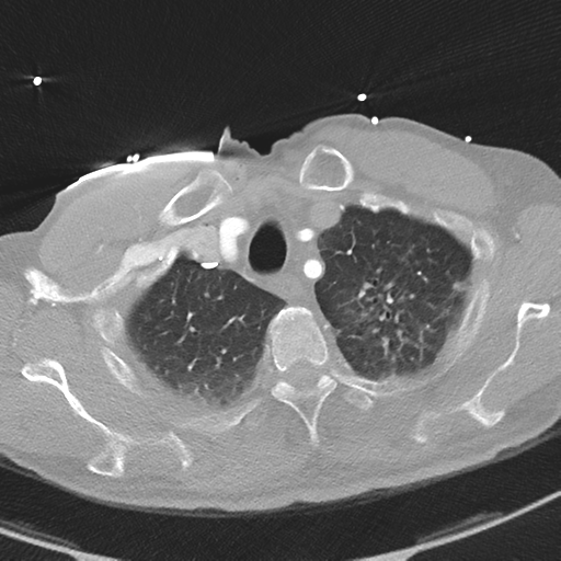 Aortic dissection - DeBakey type II (Radiopaedia 64302-73082 Axial lung window 11).png