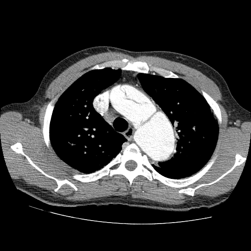 File:Aortic dissection - Stanford A -DeBakey I (Radiopaedia 28339-28587 B 13).jpg