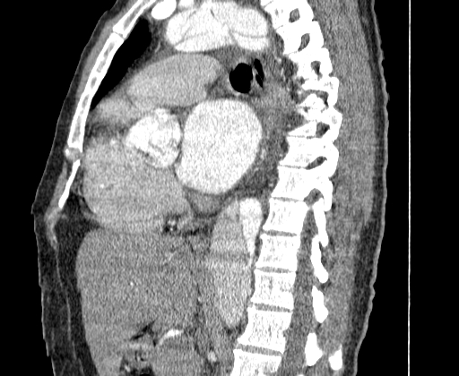 Aortic dissection - Stanford A -DeBakey I (Radiopaedia 28339-28587 C 33).jpg