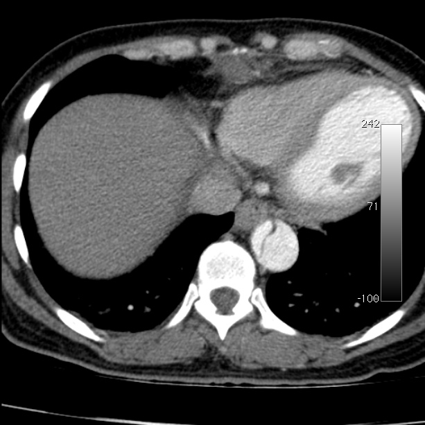 Aortic dissection - Stanford type A (Radiopaedia 29247-29659 A 60).jpg