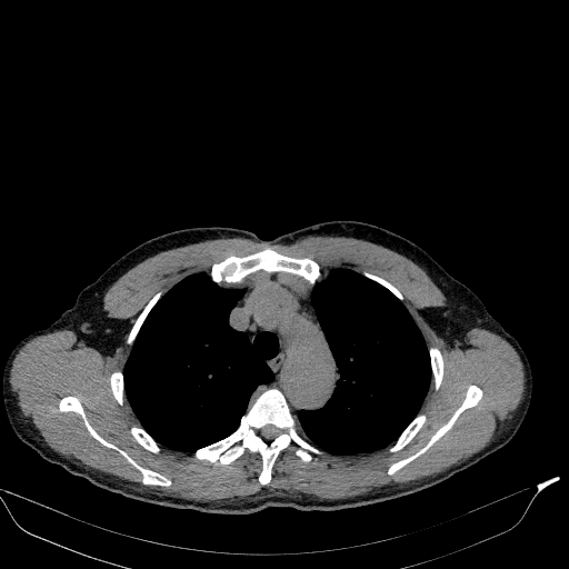 File:Aortic dissection - Stanford type A (Radiopaedia 83418-98500 Axial non-contrast 10).jpg