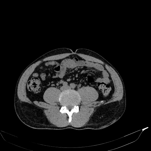 File:Aortic dissection - Stanford type A (Radiopaedia 83418-98500 Axial non-contrast 66).jpg