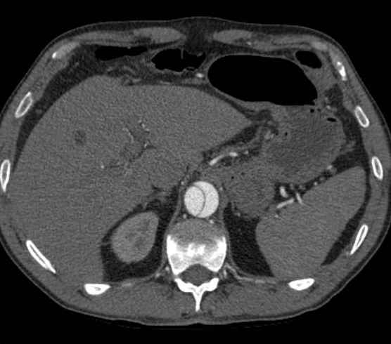 Aortic dissection - Stanford type B (Radiopaedia 73648-84437 A 114).jpg