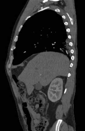 File:Aortic dissection - Stanford type B (Radiopaedia 73648-84437 C 117).jpg