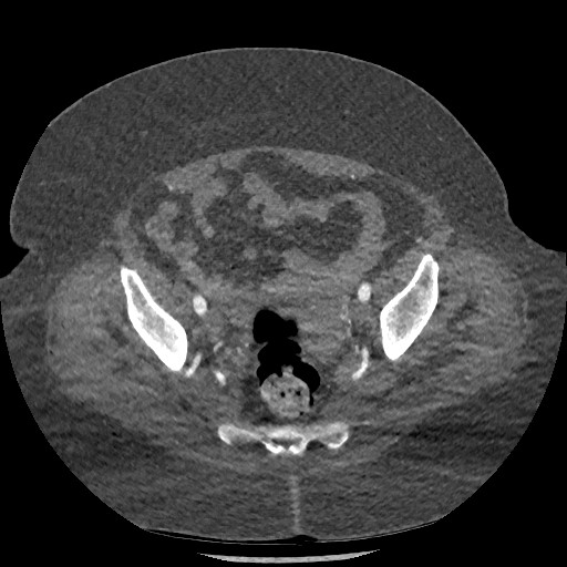 Aortic dissection - Stanford type B (Radiopaedia 88281-104910 A 149).jpg