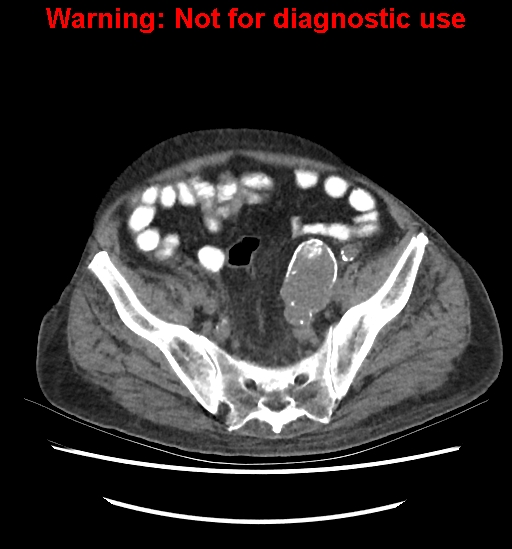 Aortic graft infection (Radiopaedia 44979-48907 Axial non-contrast 76).jpg