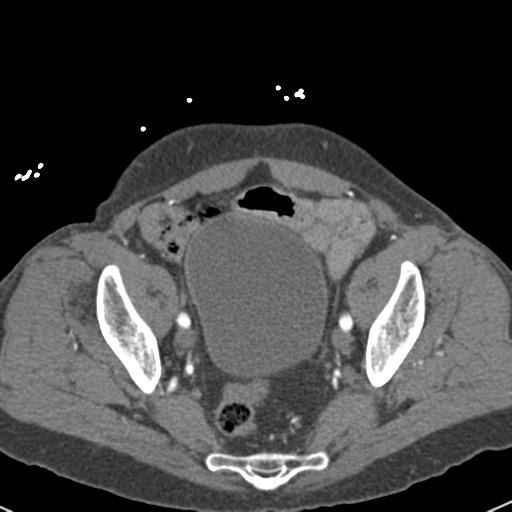 File:Aortic intramural hematoma (Radiopaedia 31139-31838 B 150).jpg
