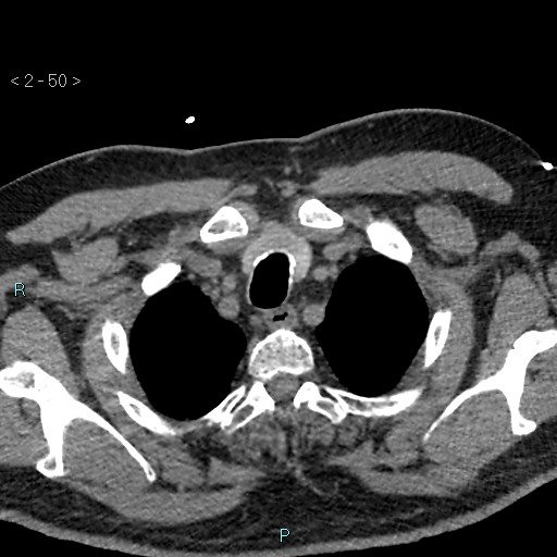 Aortic intramural hematoma (Radiopaedia 48463-53380 Axial non-contrast 22).jpg