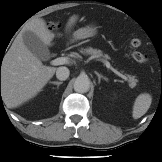 File:Aortic intramural hematoma (type B) (Radiopaedia 79323-92387 Axial C+ delayed 59).jpg