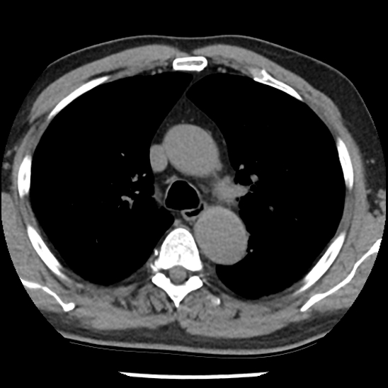 Aortic intramural hematoma (type B) (Radiopaedia 79323-92387 Axial non-contrast 17).jpg