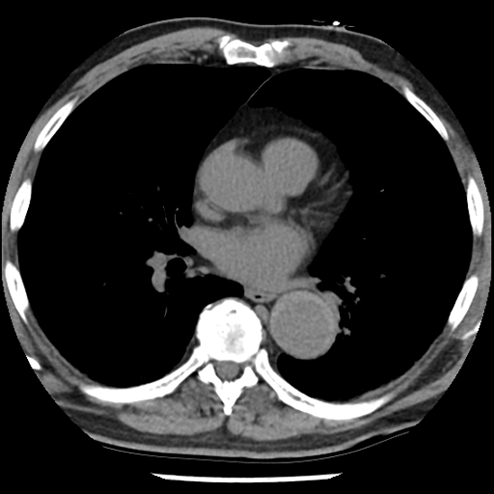 Aortic intramural hematoma (type B) (Radiopaedia 79323-92387 Axial non-contrast 29).jpg