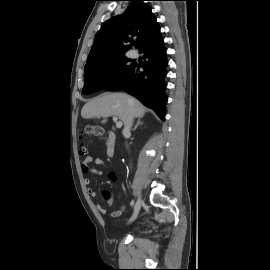 Aortic intramural hematoma (type B) (Radiopaedia 79323-92387 Sagittal C+ delayed 17).jpg