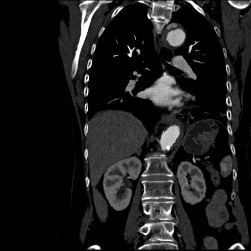 File:Aortic intramural hematoma from penetrating atherosclerotic ulcer (Radiopaedia 31137-31836 C 40).jpg