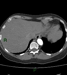 Aortic valve endocarditis (Radiopaedia 87209-103485 C 83).jpg