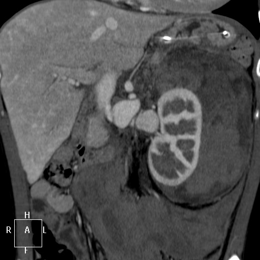 File:Aorto-left renal vein fistula (Radiopaedia 45534-49628 B 25).jpg