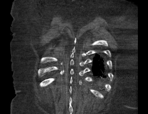 Aortoesophageal fistula with endovascular repair (Radiopaedia 73781-84592 Coronal C+ CTPA 128).jpg