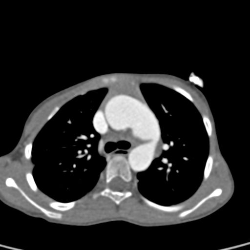 File:Aortopulmonary window, interrupted aortic arch and large PDA giving the descending aorta (Radiopaedia 35573-37074 B 30).jpg