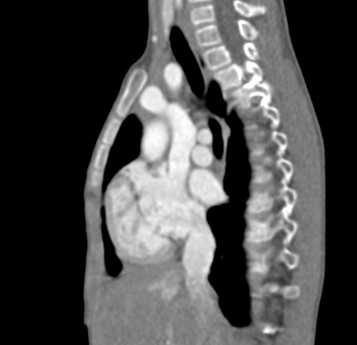 File:Aortopulmonary window, interrupted aortic arch and large PDA giving the descending aorta (Radiopaedia 35573-37074 C 7).jpg