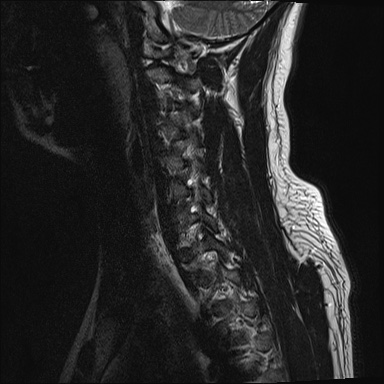 File:Apical lung mass mimic - neurogenic tumor (Radiopaedia 59918-67394 Sagittal T2 5).jpg
