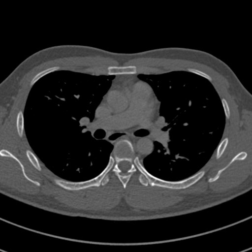 File:Apical lung mass mimic - neurogenic tumor (Radiopaedia 59918-67521 Axial bone window 36).jpg