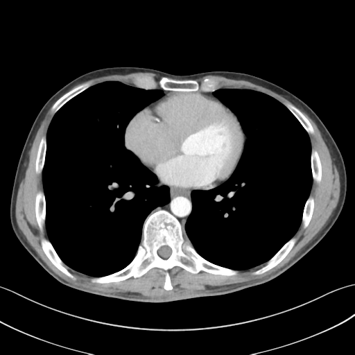 Apical pleural calcification (Radiopaedia 46141-50499 Axial C+ delayed 44).png