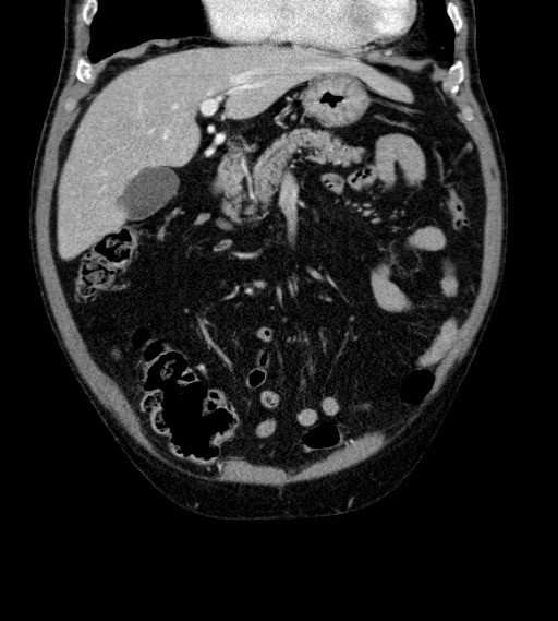 Appendiceal adenocarcinoma complicated by retroperitoneal abscess (Radiopaedia 58007-65039 A 28).jpg